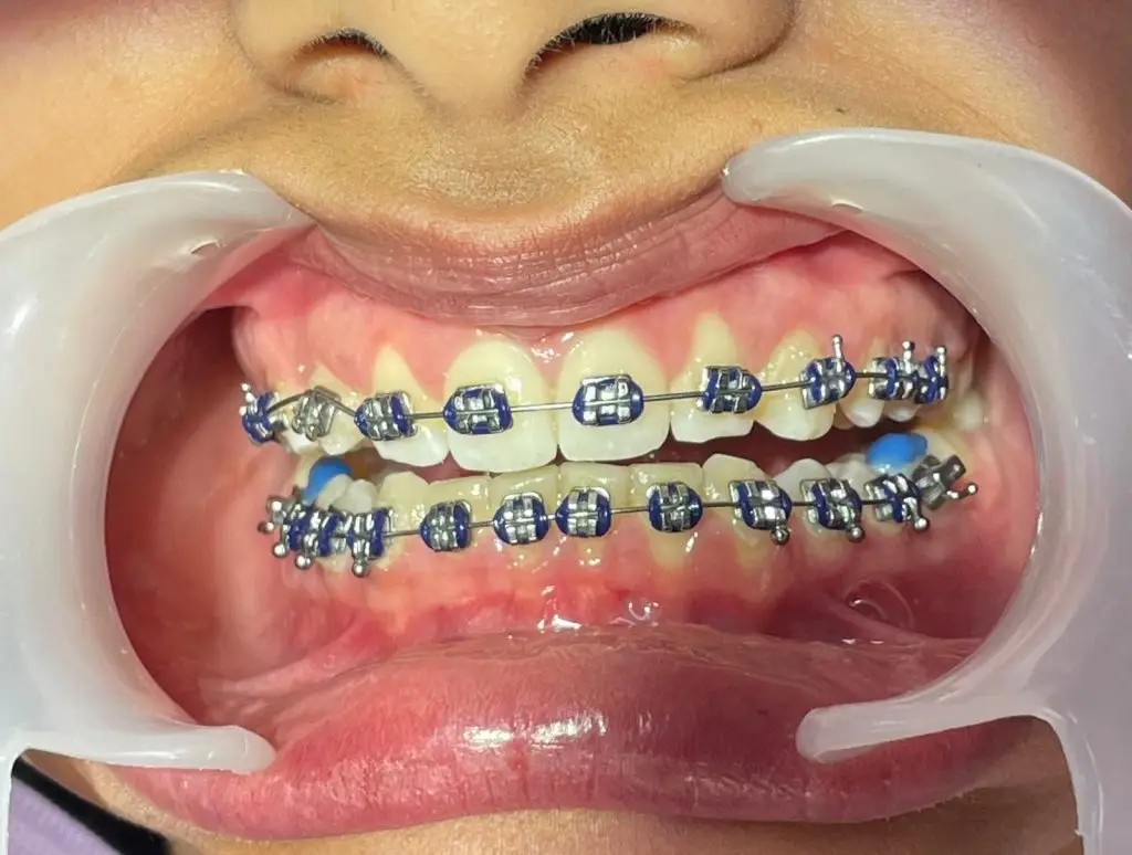 Aparelho dentário fixo com brackets metálicos